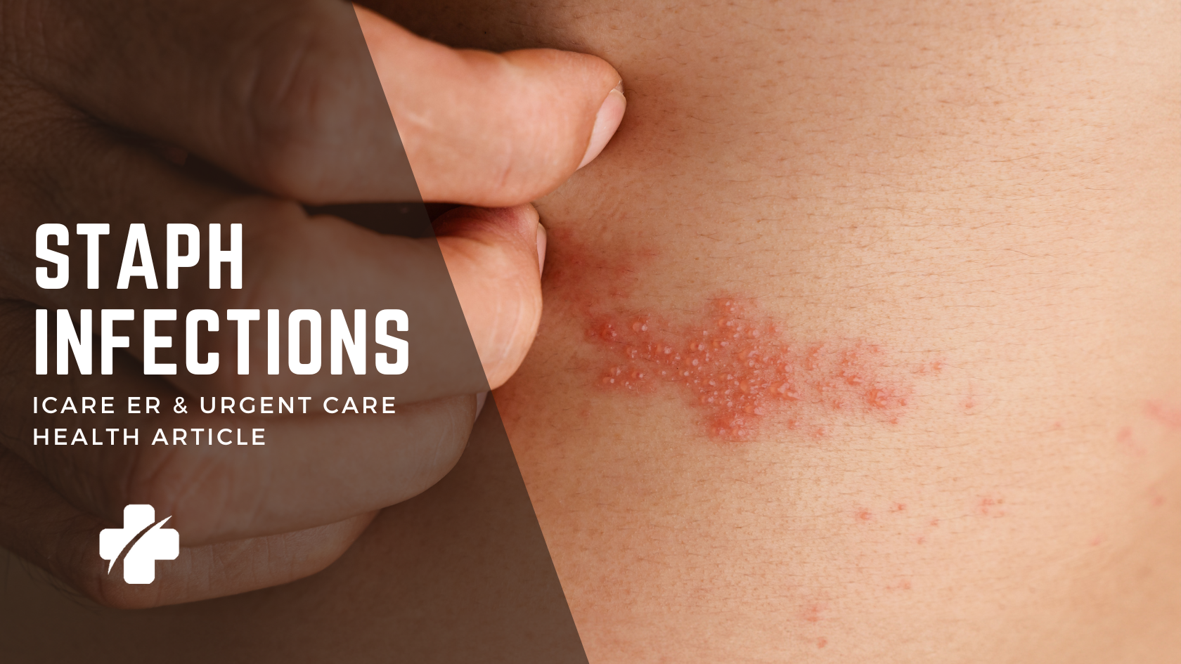 Solving the Mystery of Groin Rashes: What You Need to Know 